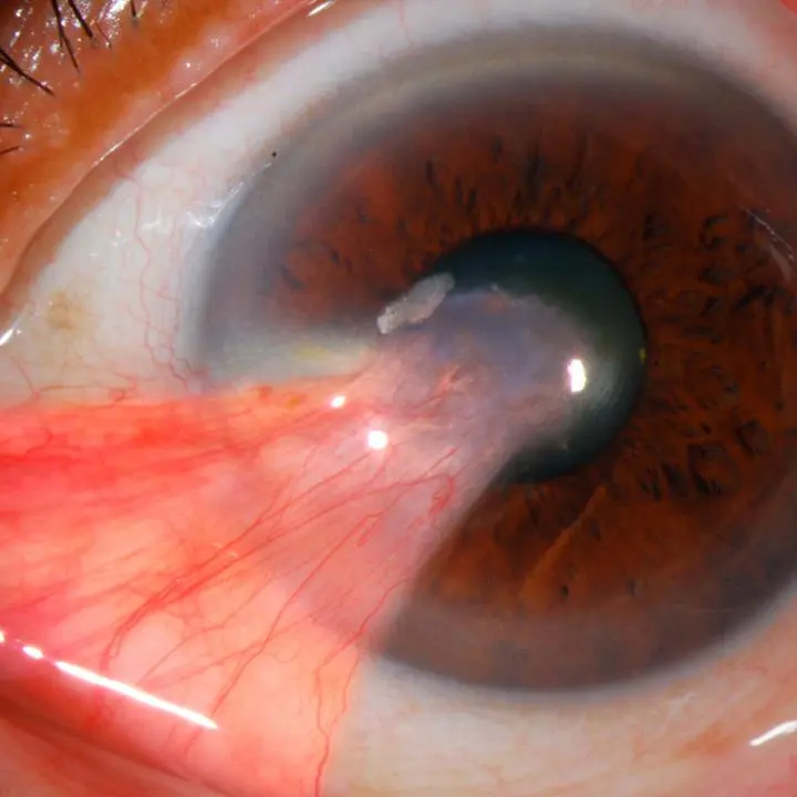 Carnosidad en los Ojos: Síntomas, Causas y Tratamientos